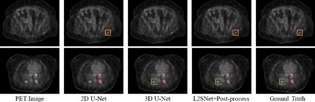 Figure 4 for A Localization-to-Segmentation Framework for Automatic Tumor Segmentation in Whole-Body PET/CT Images