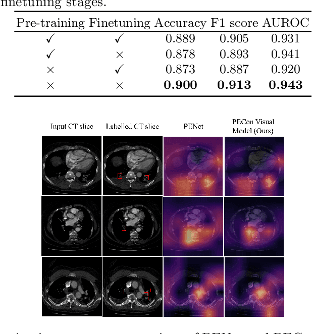 Figure 4 for PECon: Contrastive Pretraining to Enhance Feature Alignment between CT and EHR Data for Improved Pulmonary Embolism Diagnosis