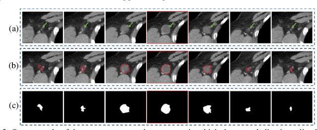 Figure 4 for Evaluating the Effectiveness of 2D and 3D Features for Predicting Tumor Response to Chemotherapy