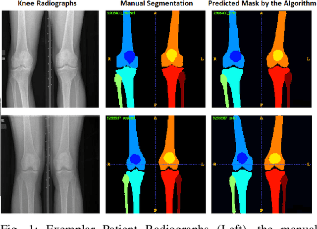 Figure 1 for Learning Unbiased Image Segmentation: A Case Study with Plain Knee Radiographs