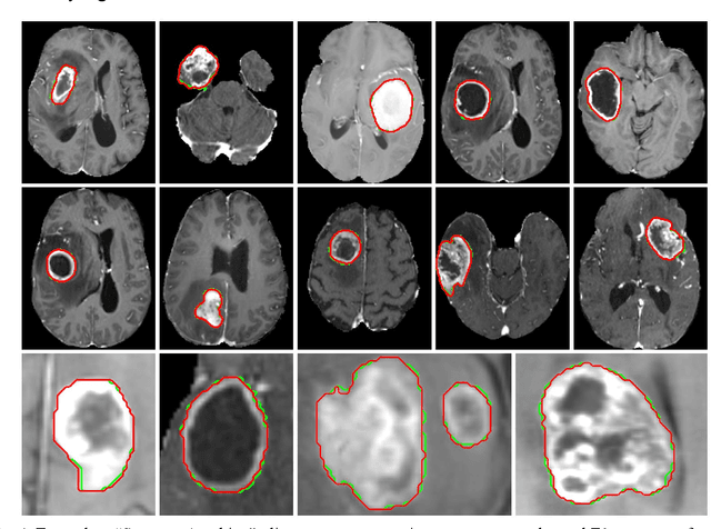 Figure 1 for The Segment Anything foundation model achieves favorable brain tumor autosegmentation accuracy on MRI to support radiotherapy treatment planning