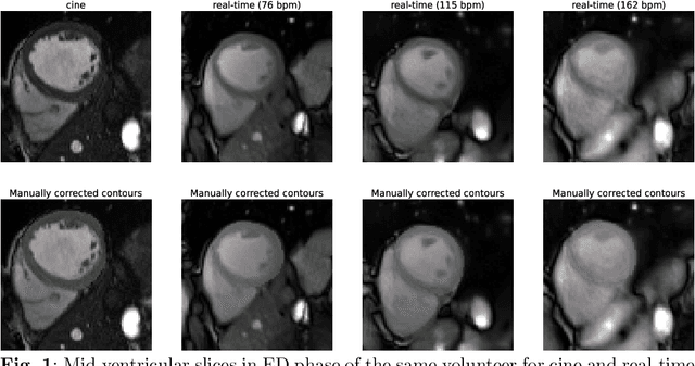 Figure 2 for Assessment of Deep Learning Segmentation for Real-Time Free-Breathing Cardiac Magnetic Resonance Imaging