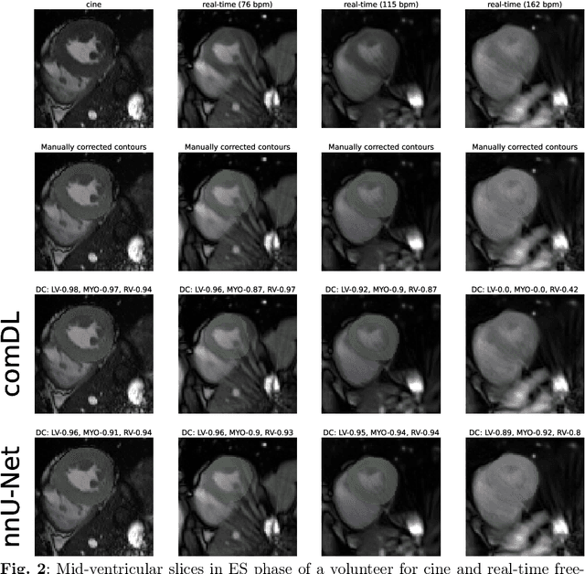 Figure 3 for Assessment of Deep Learning Segmentation for Real-Time Free-Breathing Cardiac Magnetic Resonance Imaging