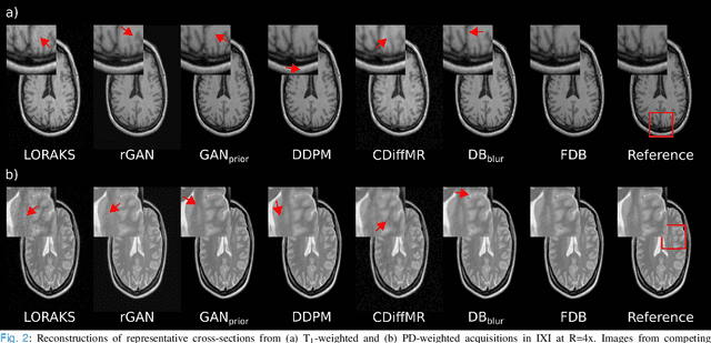 Figure 2 for Learning Fourier-Constrained Diffusion Bridges for MRI Reconstruction