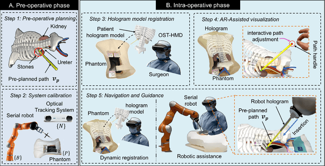 Figure 3 for Augmented Reality and Human-Robot Collaboration Framework for Percutaneous Nephrolithotomy