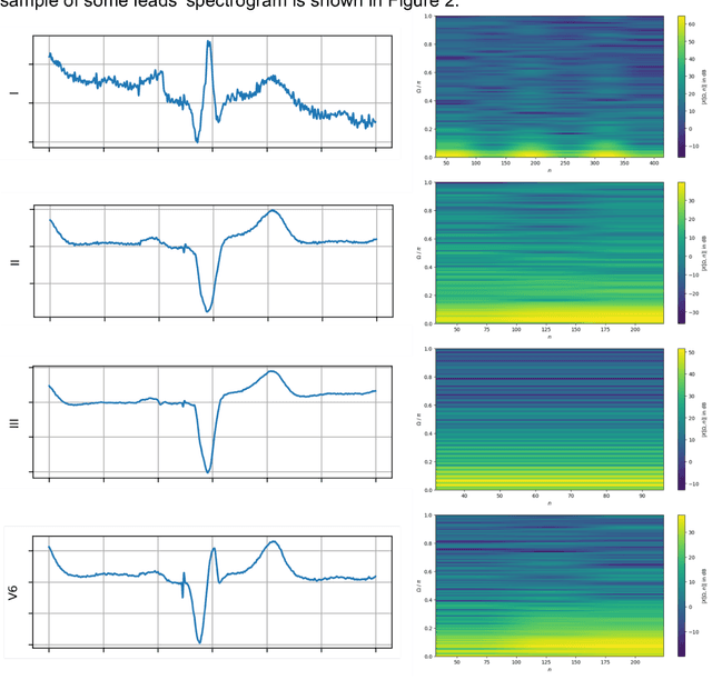 Figure 3 for A new method using deep transfer learning on ECG to predict the response to cardiac resynchronization therapy