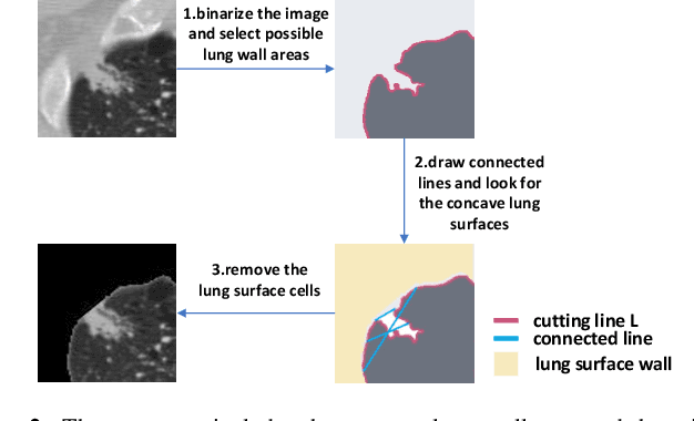 Figure 3 for A Coarse-to-fine Morphological Approach With Knowledge-based Rules and Self-adapting Correction for Lung Nodules Segmentation