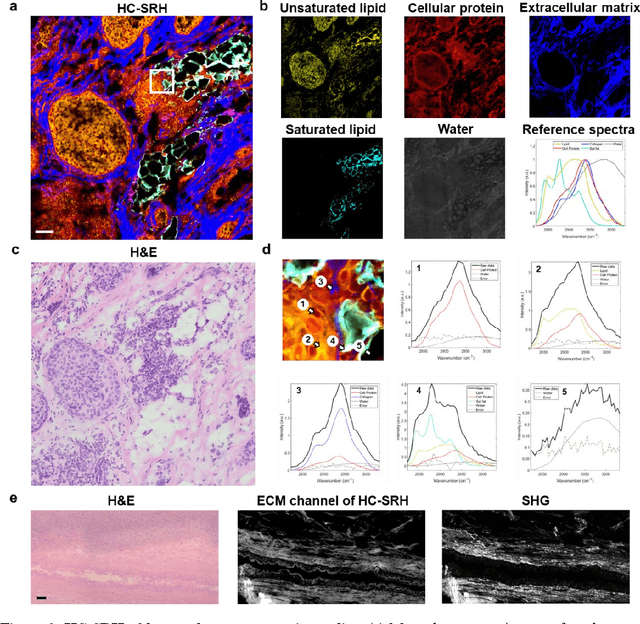 Figure 2 for High-content stimulated Raman histology of human breast cancer