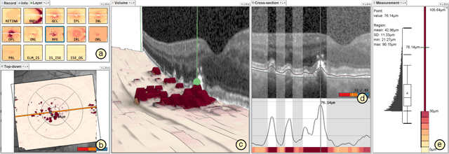 Figure 1 for Visual Analytics for Early Detection of Retinal Diseases