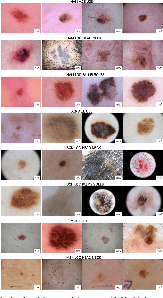 Figure 3 for Domain shifts in dermoscopic skin cancer datasets: Evaluation of essential limitations for clinical translation