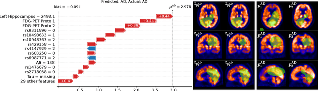 Figure 4 for Don't PANIC: Prototypical Additive Neural Network for Interpretable Classification of Alzheimer's Disease
