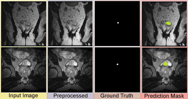 Figure 3 for Enhancing Prostate Cancer Diagnosis with Deep Learning: A Study using mpMRI Segmentation and Classification