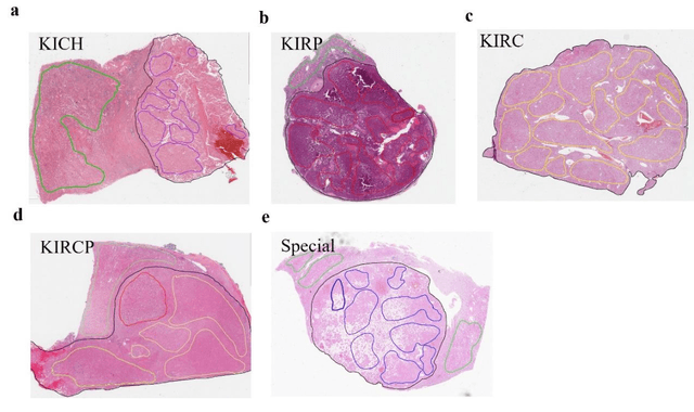 Figure 3 for RCdpia: A Renal Carcinoma Digital Pathology Image Annotation dataset based on pathologists
