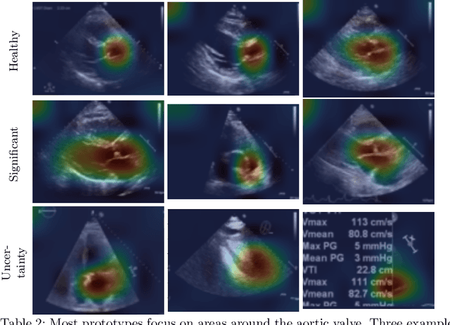 Figure 3 for ProtoASNet: Dynamic Prototypes for Inherently Interpretable and Uncertainty-Aware Aortic Stenosis Classification in Echocardiography