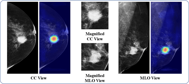Figure 3 for Classification of Luminal Subtypes in Full Mammogram Images Using Transfer Learning