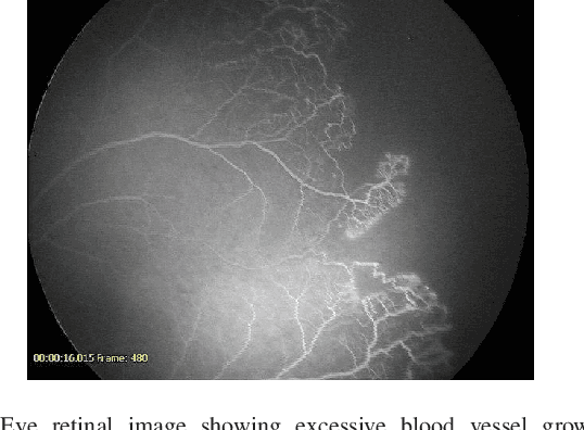 Figure 1 for Deep Learning Methods for Retinal Blood Vessel Segmentation: Evaluation on Images with Retinopathy of Prematurity