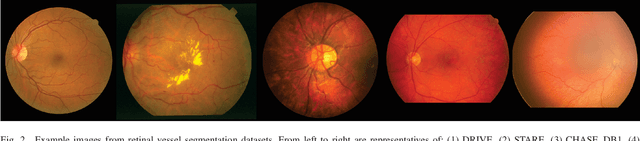 Figure 2 for Deep Learning Methods for Retinal Blood Vessel Segmentation: Evaluation on Images with Retinopathy of Prematurity