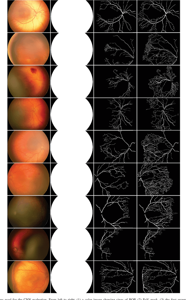 Figure 3 for Deep Learning Methods for Retinal Blood Vessel Segmentation: Evaluation on Images with Retinopathy of Prematurity