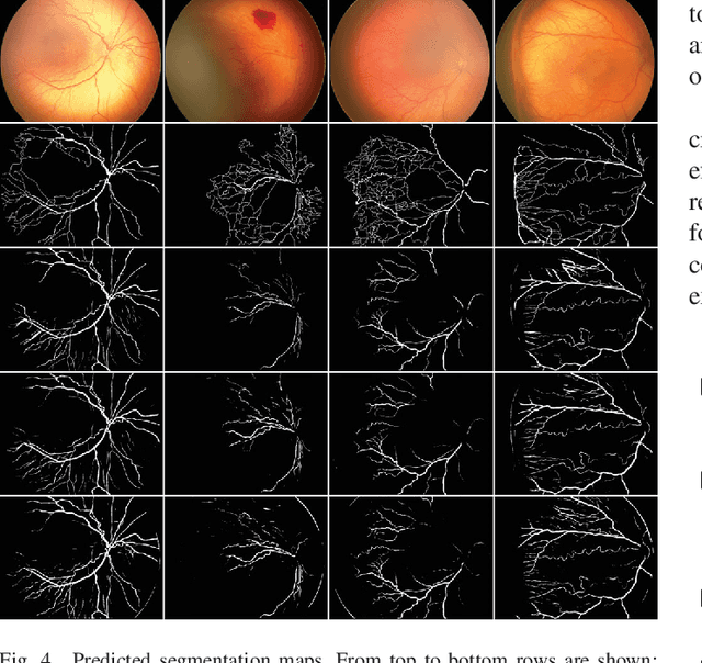 Figure 4 for Deep Learning Methods for Retinal Blood Vessel Segmentation: Evaluation on Images with Retinopathy of Prematurity