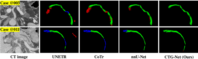 Figure 3 for CTG-Net: An Efficient Cascaded Framework Driven by Terminal Guidance Mechanism for Dilated Pancreatic Duct Segmentation