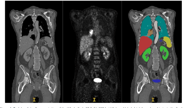 Figure 1 for Improving Lesion Segmentation in FDG-18 Whole-Body PET/CT scans using Multilabel approach: AutoPET II challenge