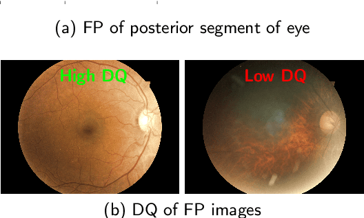 Figure 3 for Diagnostic Quality Assessment of Fundus Photographs: Hierarchical Deep Learning with Clinically Significant Explanations