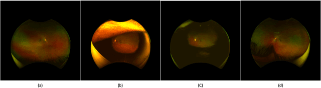 Figure 4 for Automated Artifact Detection in Ultra-widefield Fundus Photography of Patients with Sickle Cell Disease