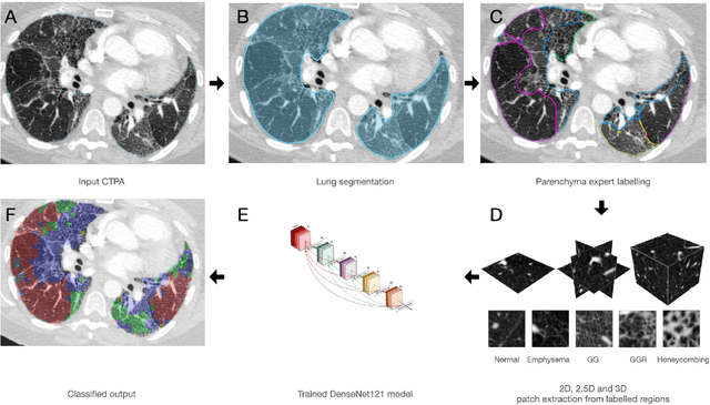 Figure 4 for Deep learning automated quantification of lung disease in pulmonary hypertension on CT pulmonary angiography: A preliminary clinical study with external validation