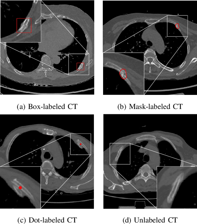 Figure 1 for Deep Omni-supervised Learning for Rib Fracture Detection from Chest Radiology Images
