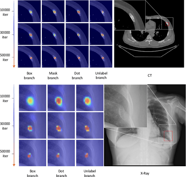 Figure 3 for Deep Omni-supervised Learning for Rib Fracture Detection from Chest Radiology Images
