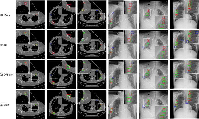 Figure 4 for Deep Omni-supervised Learning for Rib Fracture Detection from Chest Radiology Images