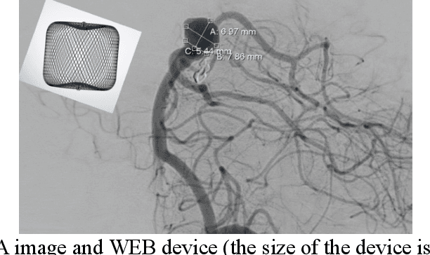 Figure 1 for Towards Automatic Prediction of Outcome in Treatment of Cerebral Aneurysms