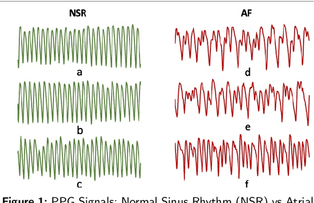 Figure 1 for Contrastive Self-Supervised Learning Based Approach for Patient Similarity: A Case Study on Atrial Fibrillation Detection from PPG Signal