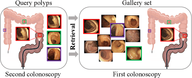 Figure 1 for Towards Discriminative Representation with Meta-learning for Colonoscopic Polyp Re-Identification