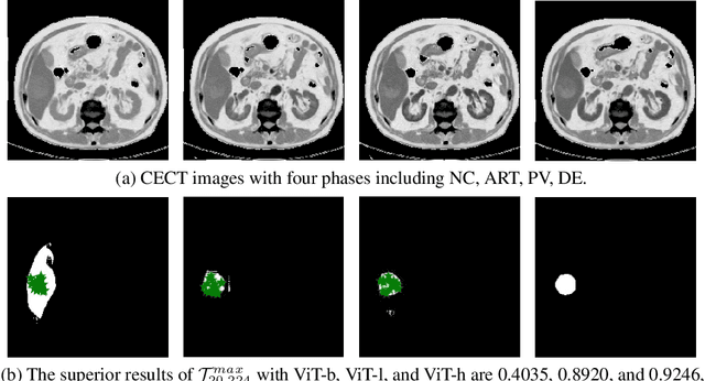 Figure 3 for When SAM Meets Medical Images: An Investigation of Segment Anything Model (SAM) on Multi-phase Liver Tumor Segmentation