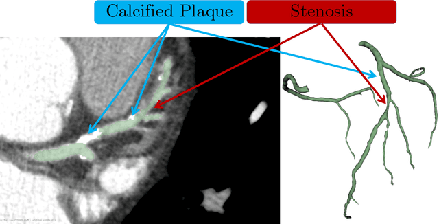 Figure 4 for Computed tomography coronary angiogram images, annotations and associated data of normal and diseased arteries