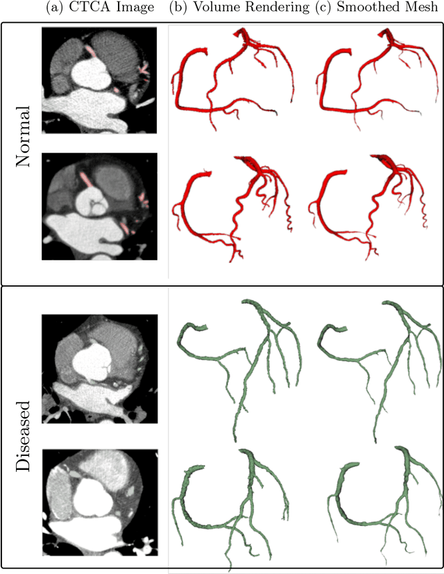 Figure 2 for Computed tomography coronary angiogram images, annotations and associated data of normal and diseased arteries