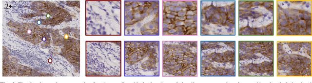 Figure 4 for Mimicking a Pathologist: Dual Attention Model for Scoring of Gigapixel Histology Images