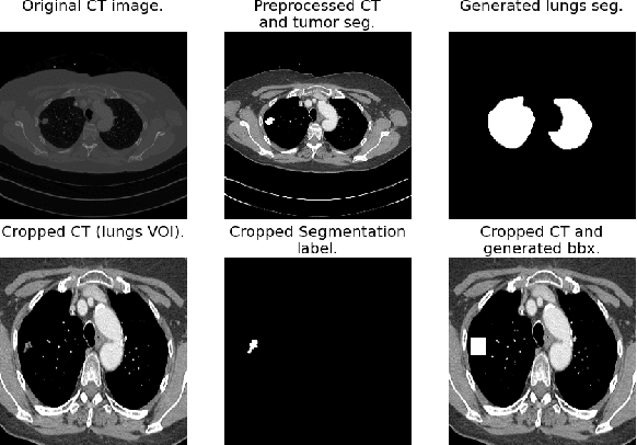 Figure 1 for A Radiogenomics Pipeline for Lung Nodules Segmentation and Prediction of EGFR Mutation Status from CT Scans