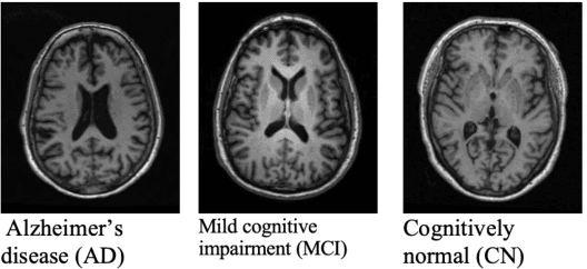 Figure 3 for Transfer Learning and Class Decomposition for Detecting the Cognitive Decline of Alzheimer Disease