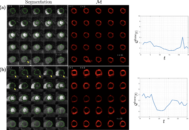 Figure 4 for Temporal Uncertainty Localization to Enable Human-in-the-loop Analysis of Dynamic Contrast-enhanced Cardiac MRI Datasets