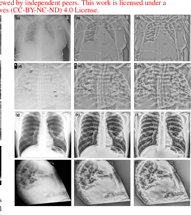 Figure 3 for On The Application Of Log Compression and Enhanced Denoising In Contrast Enhancement Of Digital Radiography Images