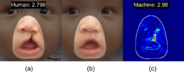 Figure 1 for Unsupervised Anomaly Appraisal of Cleft Faces Using a StyleGAN2-based Model Adaptation Technique