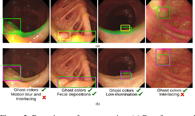Figure 3 for Can Adversarial Networks Make Uninformative Colonoscopy Video Frames Clinically Informative?