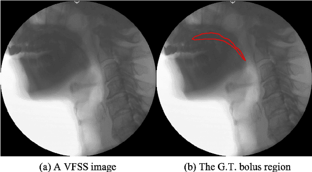 Figure 1 for PECI-Net: Bolus segmentation from video fluoroscopic swallowing study images using preprocessing ensemble and cascaded inference