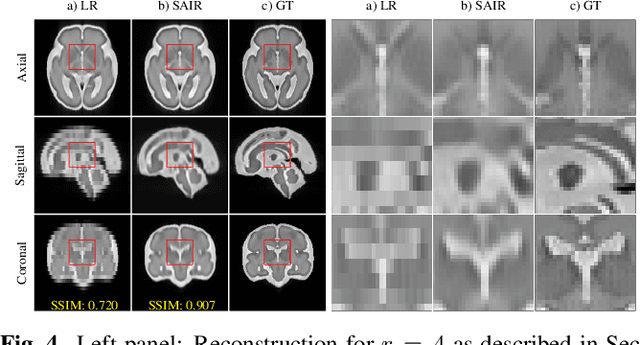 Figure 4 for Self-Supervised Isotropic Superresolution Fetal Brain MRI