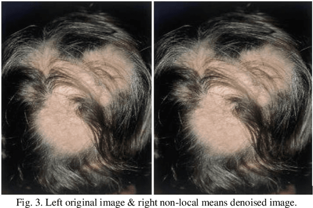 Figure 3 for Hair and Scalp Disease Detection using Machine Learning and Image Processing