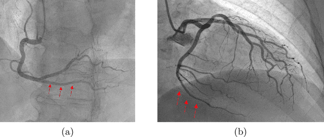 Figure 1 for Neural network-based coronary dominance classification of RCA angiograms