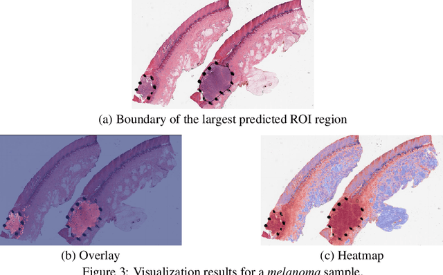 Figure 4 for Region of Interest Detection in Melanocytic Skin Tumor Whole Slide Images