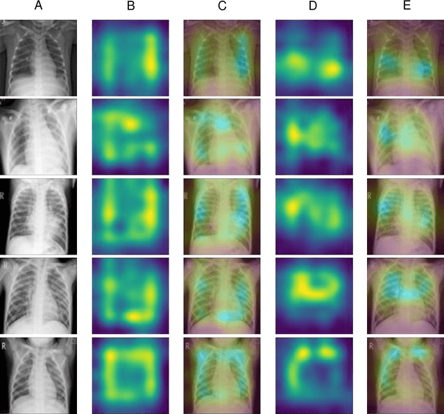 Figure 4 for Unlearning Spurious Correlations in Chest X-ray Classification